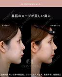 忘れ鼻整形 180日後 サムネイル用