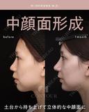 忘れ鼻整形 30日後 サムネイル用