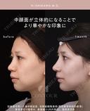 忘れ鼻整形 30日後 サムネイル用