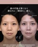 忘れ鼻整形 30日後 サムネイル用