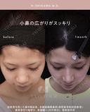 忘れ鼻整形 30日後 サムネイル用