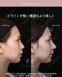 忘れ鼻整形 30日後 サムネイル用