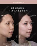 忘れ鼻整形 30日後 サムネイル用