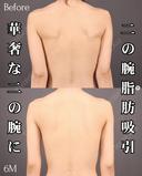ベイザー二の腕＋肩脂肪吸引 180日後 サムネイル用