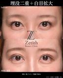 埋没クロス法＋下眼瞼下制（糸） 7日後 サムネイル用