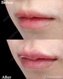 唇ヒアルロン酸 before画像 サムネイル用