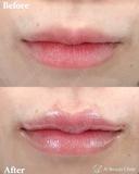 唇ヒアルロン酸 after画像 サムネイル用