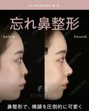 忘れ鼻整形 before画像 サムネイル用