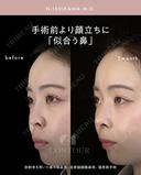 忘れ鼻整形 90日後 サムネイル用