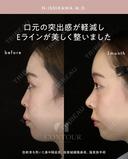 忘れ鼻整形 90日後 サムネイル用