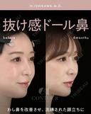忘れ鼻整形 before画像 サムネイル用