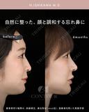 忘れ鼻整形 180日後 サムネイル用