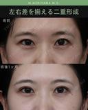 左右差を揃える二重形成 before画像 サムネイル用