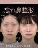 忘れ鼻整形 before画像 サムネイル用