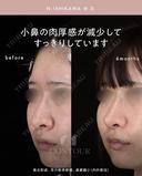 忘れ鼻整形 180日後 サムネイル用