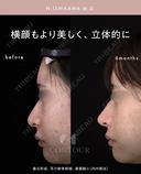 忘れ鼻整形 180日後 サムネイル用