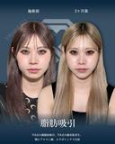 顔の脂肪吸引＋小顔美肌再生（リフトアップ）＋顎（あご）のヒアルロン酸注射＋エラのボトックス小顔注射 60日後 サムネイル用