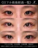 ナチュラル目フル before画像 サムネイル用