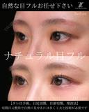 ナチュラル目フル 30日後 サムネイル用