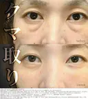 クマ取りで疲れ顔解消🧸 before画像 サムネイル用
