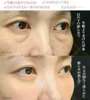 クマ取りで疲れ顔解消🧸 7日後 サムネイル用