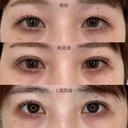 二重埋没法 before画像 サムネイル用