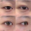 二重埋没法 before画像 サムネイル用