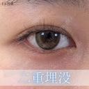 二重埋没法 30日後 サムネイル用