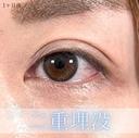 二重埋没法 30日後 サムネイル用