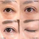 二重埋没法 before画像 サムネイル用