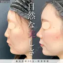 ツンとした美鼻に♡鼻尖形成3D法+軟骨移植 after画像 サムネイル用