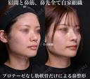 プロテーゼなし肋軟骨だけによる鼻整形 180日後 サムネイル用