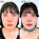 小顔美肌再生（リフトアップ）＋顔の脂肪吸引＋エラのボトックス小顔注射 30日後 サムネイル用