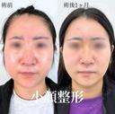 小顔美肌再生（リフトアップ）＋顔の脂肪吸引＋バッカルファット除去＋エラのボトックス小顔注射 30日後 サムネイル用