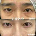 目の下の切らないたるみ取り🧸 after画像 サムネイル用