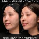肋軟骨鼻フル 90日後 サムネイル用