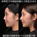 肋軟骨鼻フル 90日後 サムネイル用