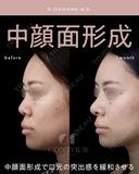 忘れ鼻整形 before画像 サムネイル用