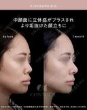 忘れ鼻整形 30日後 サムネイル用