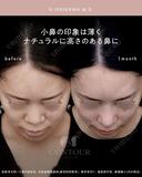 忘れ鼻整形 30日後 サムネイル用