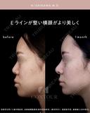 忘れ鼻整形 30日後 サムネイル用