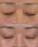 Zetith Eyes(3点留め埋没)  30日後 サムネイル用