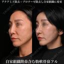 自家組織隆鼻は含む肋軟骨鼻フル 90日後 サムネイル用