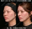 曲がっているプロテーゼを自家組織に交換 90日後 サムネイル用