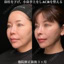 ACRを整える 90日後 サムネイル用