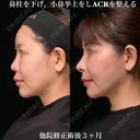 ACRを整える 90日後 サムネイル用