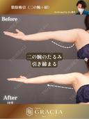 ベイザー二の腕＋肩脂肪吸引 30日後 サムネイル用