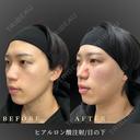 ヒアルロン酸注入術/頬コケ before画像 サムネイル用
