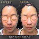 フェイスリフト/ヒアルロン酸注入 before画像 サムネイル用