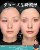 クローズ法鼻整形 30日後 サムネイル用